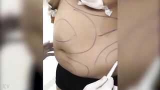 Em gái hút mỡ